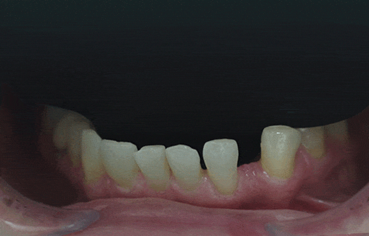 puente dental torremolinos