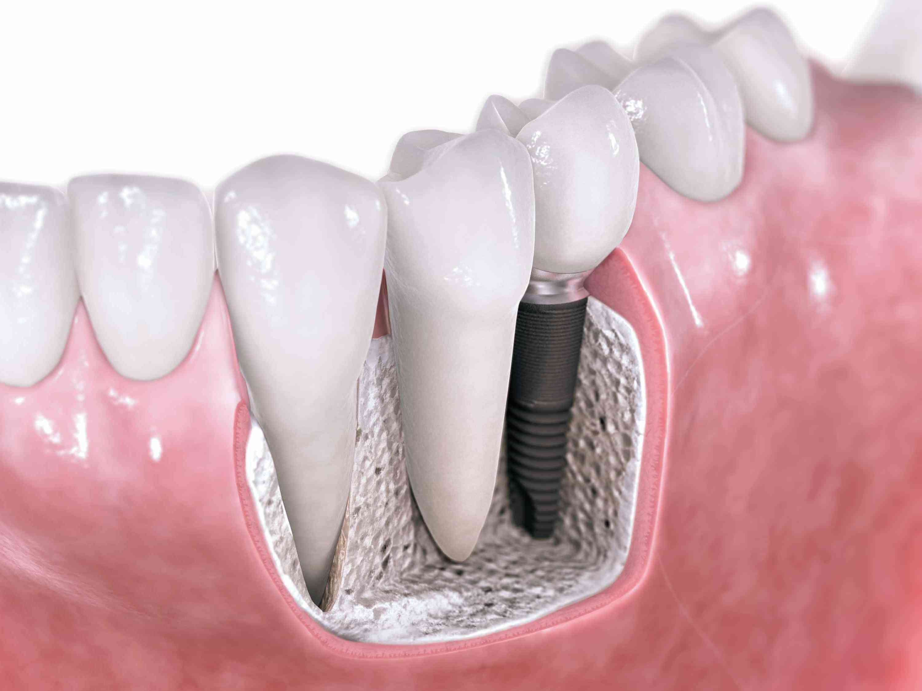implante dental torremolinos precio