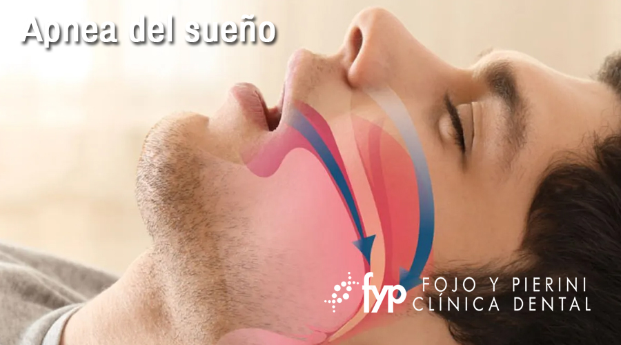 Apnea del sueño: tratamiento con férulas de avance mandibular