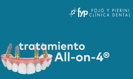 La técnica All-On-4® es un tratamiento revolucionario diseñado para pacientes que han perdido todos los dientes de una arcada (superior o inferior) o presentan una dentición muy deteriorada.