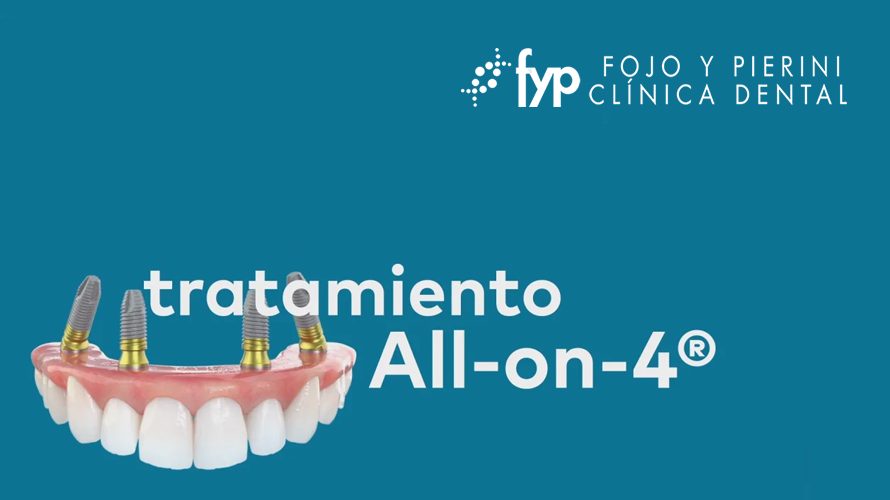 ¿Qué es la técnica All-On-4®?